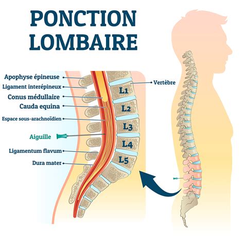 Ponction lombaire techniques et déroulement