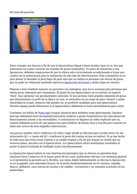 Article Lipoescultura Antes Y Despues Pdf