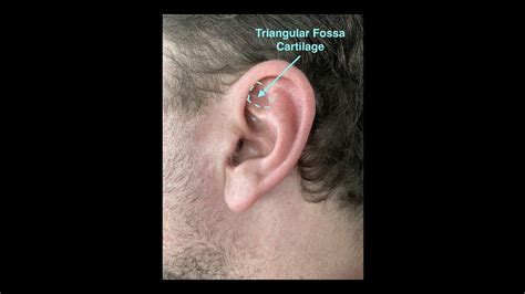 Triangular Fossa Cartilage Harvest Left Ear Youtube