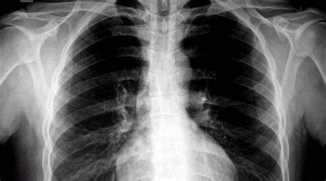 LUNG CANCER DUE TO RADON | Buyxraysonline