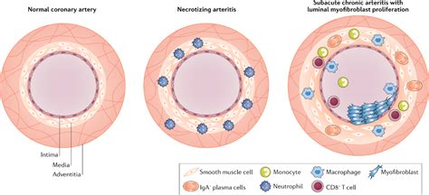 Kawasaki Disease Rcemlearning India