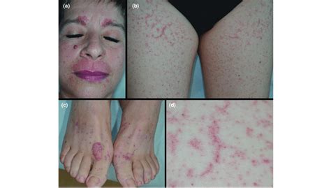 Typical Klc Clinical Features In A 55 Year Old Woman A Erythema And