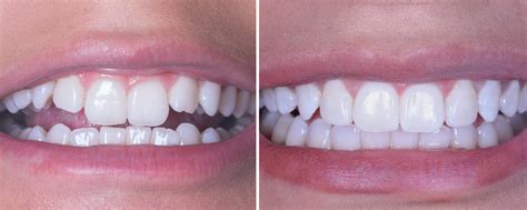 Before After Smile Makeover Gallery