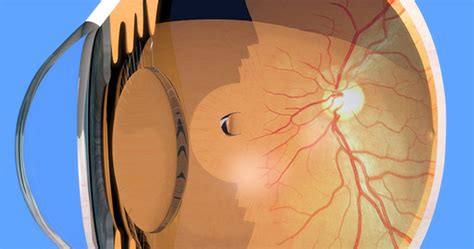 Retinal Tear And Retinal Detachment Know The Symptoms Silverstein