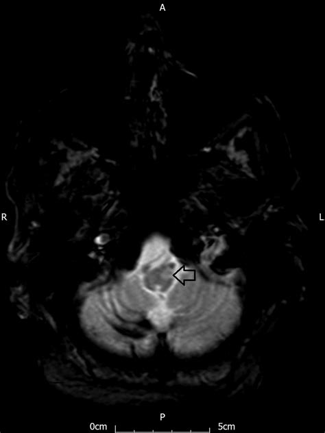 Axial T1 Weighted Magnetic Resonance Imaging Mri Sequence Showing The