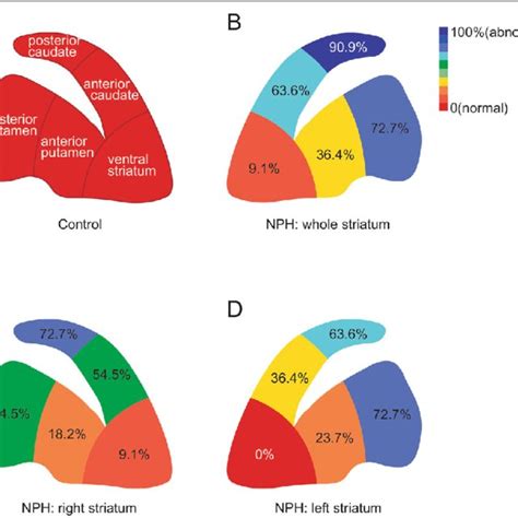 A Proportion Of Idiopathic Normal Pressure Hydrocephalus Patients Download Scientific Diagram