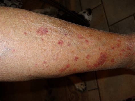 Red Dots On Legs Pictures Symptoms Causes Treatment