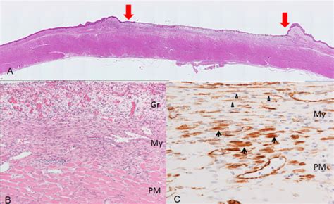 Esophageal Ulcer Histology