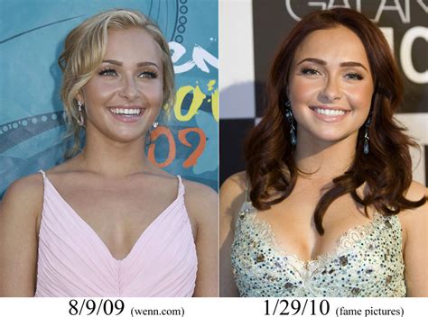 Hayden Panettiere Plastic Surgery Before and After Boob Job and Nose Job