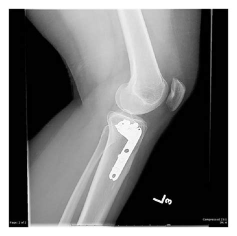 Ap And Lateral Plain Radiographs At Sixteen Months Postoperatively