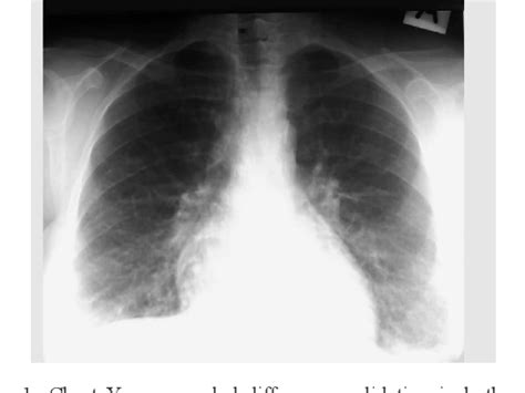 Figure From Cytomegalovirus Pneumonitis In A Patient With Homozygous