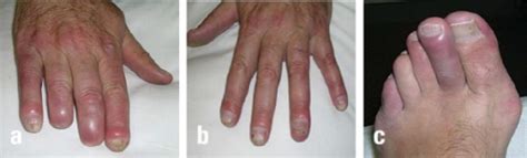 Thromboangiitis obliterans - WikEM