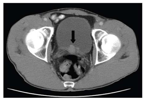 Bladder Cancer Stepwards