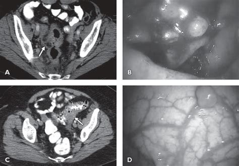 Acute diverticulitis. A and B, 61-year-old woman with acute ...