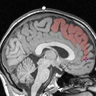 The inferior most aspect of the rostrum of the corpus callosum ...