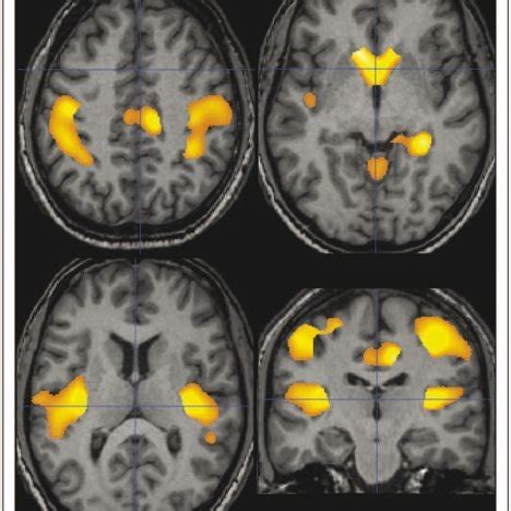 Regions Of Significant Correlation Between Grey Matter Loss And Lesion