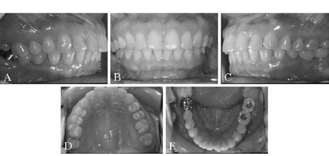 Posttreatment Intraoral Photographs A Right Buccal View B Frontal