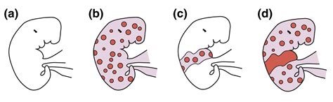 Superimposed Mosaicism In Tuberous Sclerosis Complex A Key To