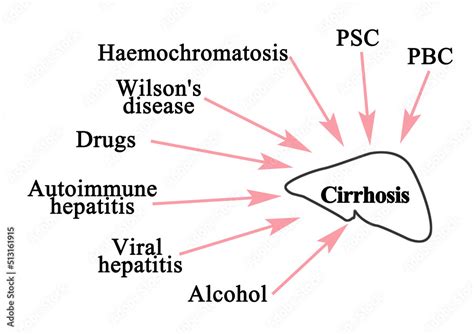 Eight major causes of Cirrhosis Stock Illustration | Adobe Stock