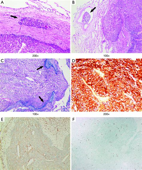 Histologic Findings Of The Resected Specimen Hematoxylin And Eosin