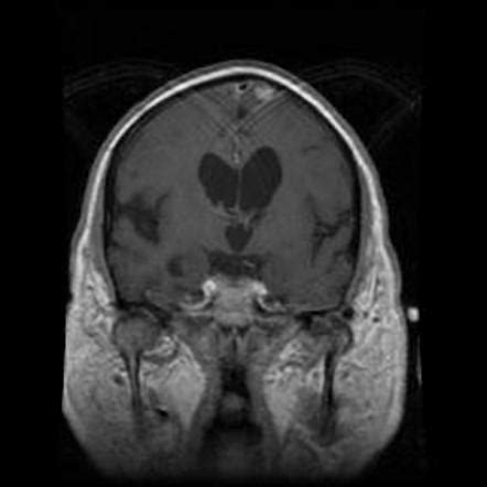 Multiple Intracranial Meningiomas Image Radiopaedia Org