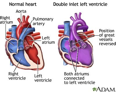 Double inlet left ventricle : MedlinePlus Medical Encyclopedia