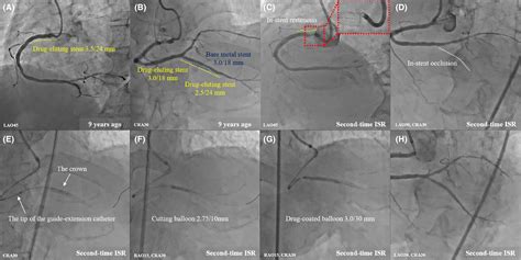 Utility Of Coronary Orbital Atherectomy With Guide‐extension System For