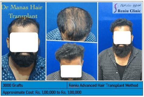 Best Hair Transplant In Mysore View Results Reniu Clinic