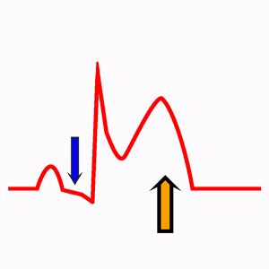 Acute Pericarditis on the Electrocardiogram