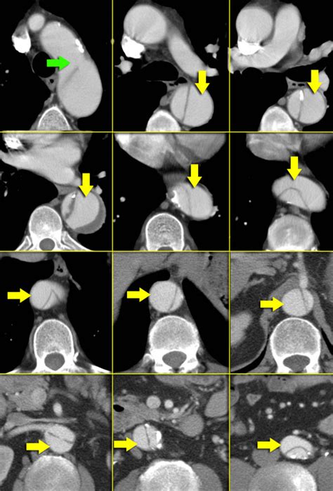 The Radiology Assistant Acute Aortic Syndrome