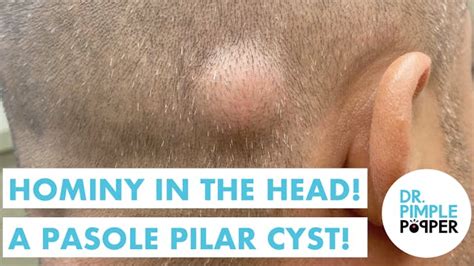 A Very HAIRY Removal on THIS Scalp Cyst! - Cystactular Cysts - Dr ...