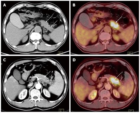 Pancreatic Cancer Ct Images Islet Cell Tumor Of The Pancreas