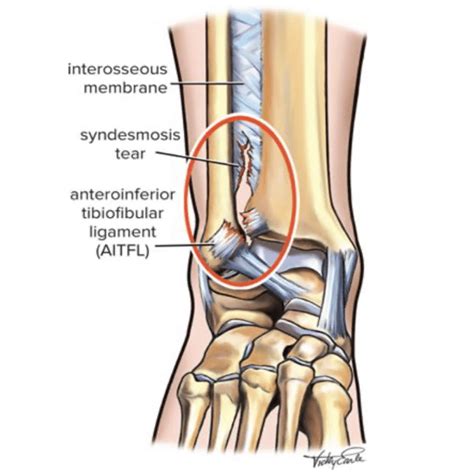 High Ankle Sprain Injuries Explained