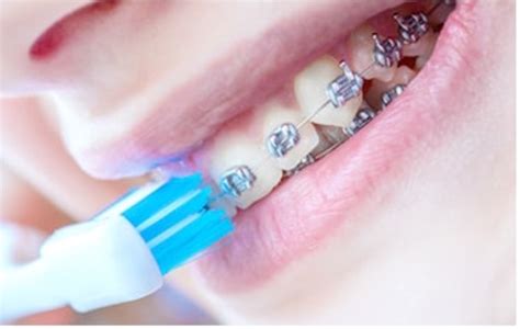 Cómo cepillarse los dientes con brackets - Clínica Dental Soler