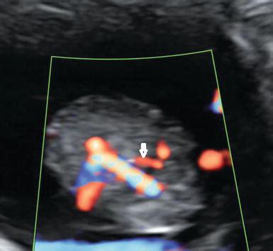 Echogenic Bowel 2 Vessel Cord