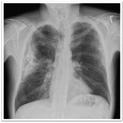 Chest X Ray Copd