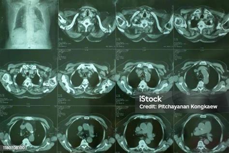 Ct Scan Dada Xray Immage Foto Stok Unduh Gambar Sekarang Pemindai