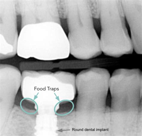 Molar Implants | Denture & Implant Solutions Colorado Springs