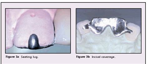 [PDF] Resin-retained Bridges Re-visited Part 2. Clinical Considerations ...