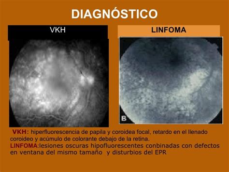 Linfoma Ocular Vs Vkh