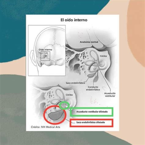 Diagnosi E Cura Della Sindrome Dellacquedotto Vestibolare Largo