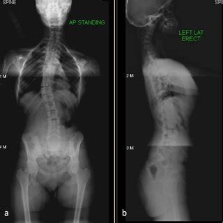 Anteroposterior A And Lateral B Radiographs Of The Whole Spine The