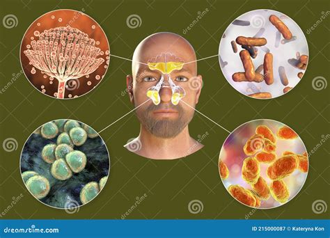 Purulent Inflammation Of Frontal And Maxillary Sinuses In A Man And