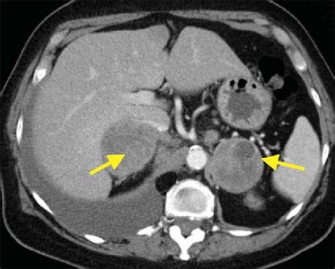 Contrast Enhanced Ct Demonstrating Large Bilateral Heterogeneous