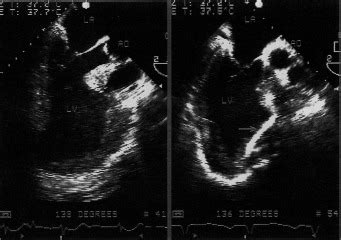 Intraoperative Multiplane Vs Biplane Transesophageal Echocardiography