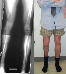 Femur Lengthening Before And After Photos Limb Lengthening