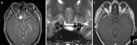 A Mr T1 Axial With Contrast Showing A 14 Mm Meningioma Of The Download Scientific Diagram