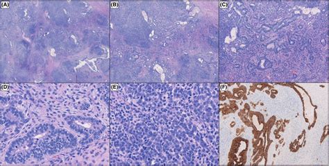 Histologic Slides Of Hematoxylin And Eosin Stains Showing Ac Highly