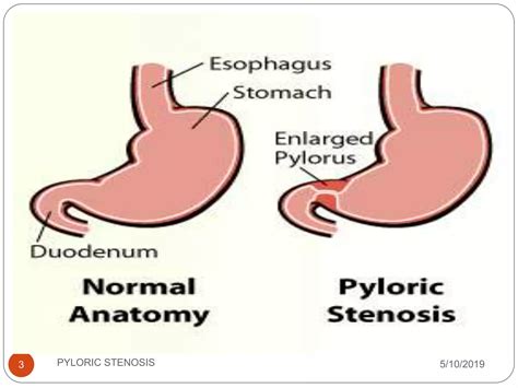 Pyloric Stenosis Ppt