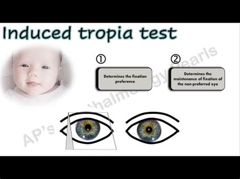 Induced Tropia Test - YouTube